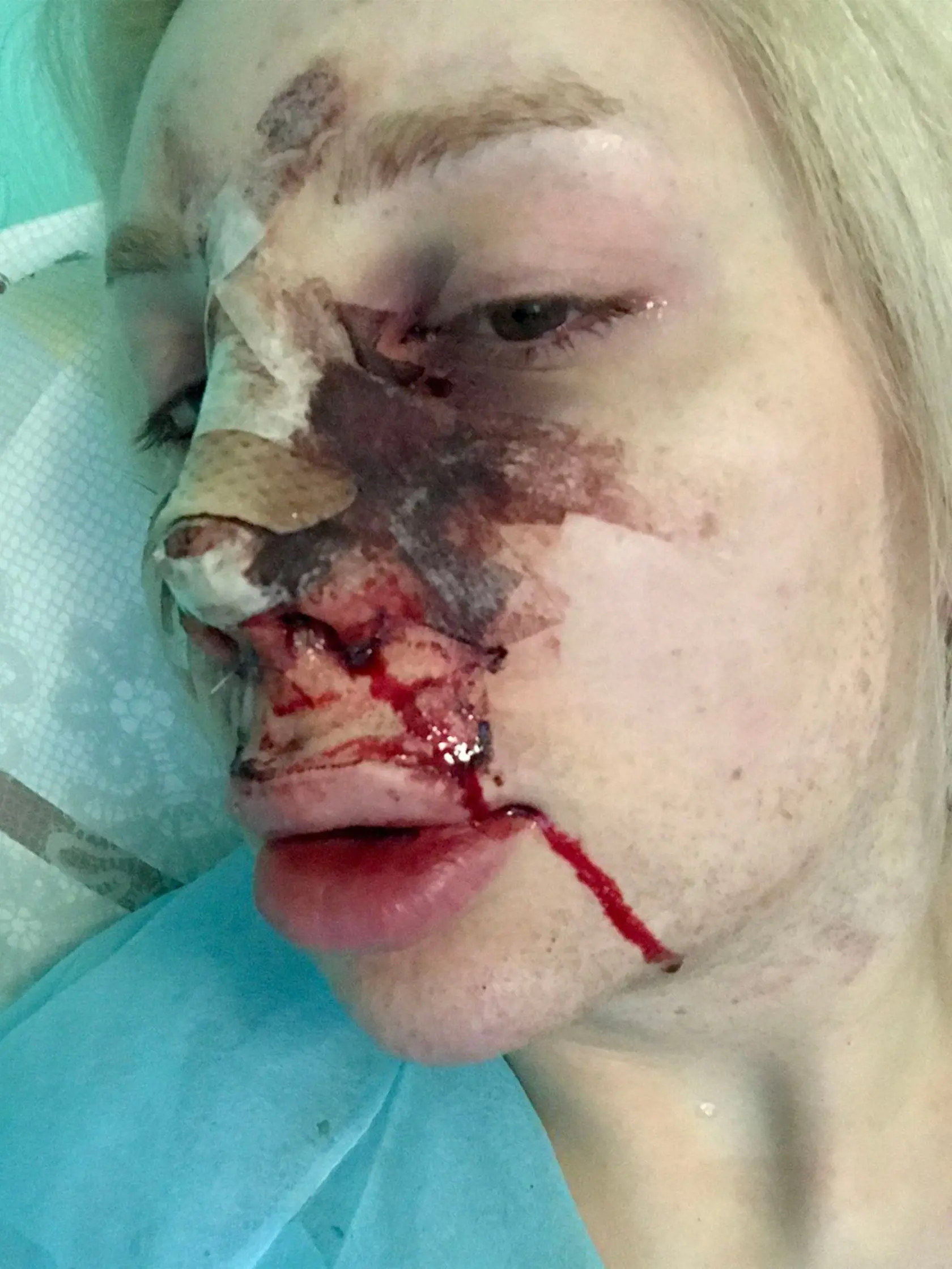 - (PICTURED: Ivana Vladislava, 26, from Berlin, Germany, who has spent over 110,000 to look like a plastic human doll. Pictured in hospital after her nose job) - A transgender woman has splashed out over 110,000 to look like a plastic human doll. Ivana Vladislava, 26, was originally born male but shortly after her 11th birthday she began taking female hormone tablets and dressed as a girl. Now, Ivana, from Berlin, Germany, has spent over 110,000 on cosmetic procedures to change her appearance fr