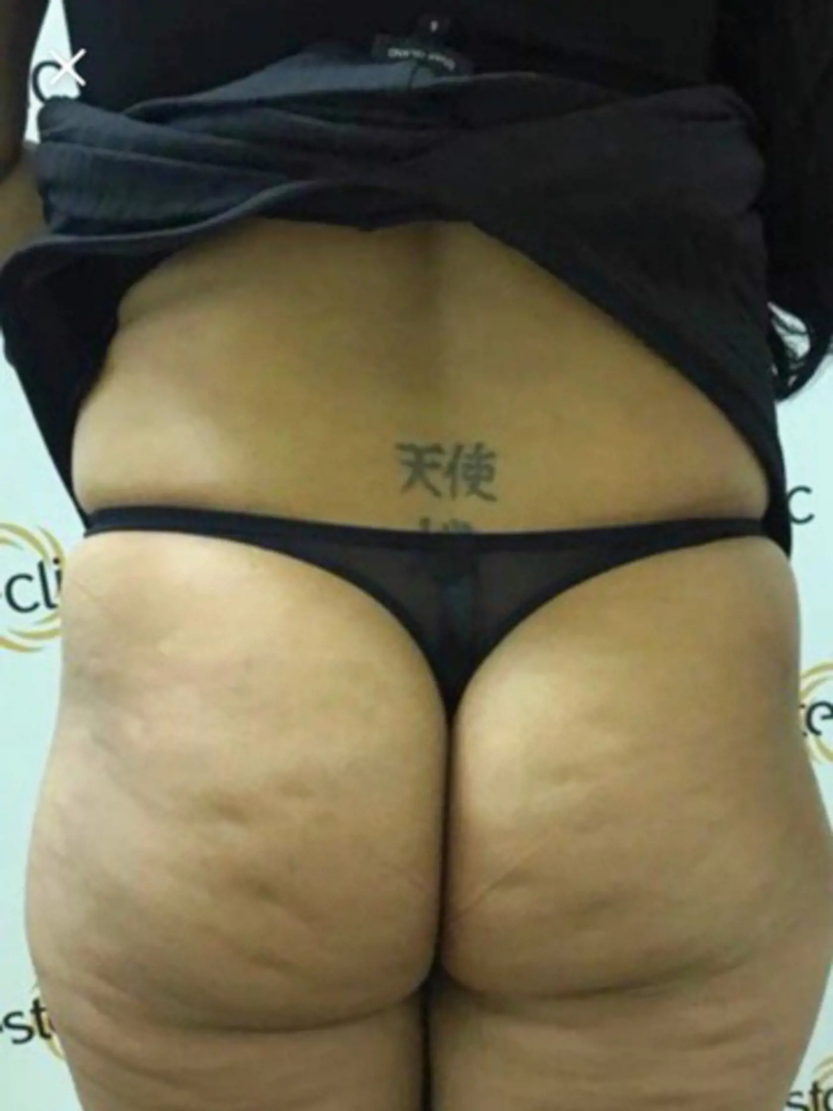 **ONLINE EMBARGO UNTIL 13:00 21/02/18**  (Pictured: Star Delguidice, 28 from Birmingham has spent 15,000 pounds on her new bum in December 2017 but has decided she no longer wants it. Stars bum before surgery. Pic taken 16/02/2018) - A surgery addict who spent 15,000 Pounds on huge bum implants just eight weeks ago now wants them removed as theyre too big. Star Delguidice, opted for implants double the recommended size and had fat drained from her thighs, arms and stomach to sculpt her perfect d
