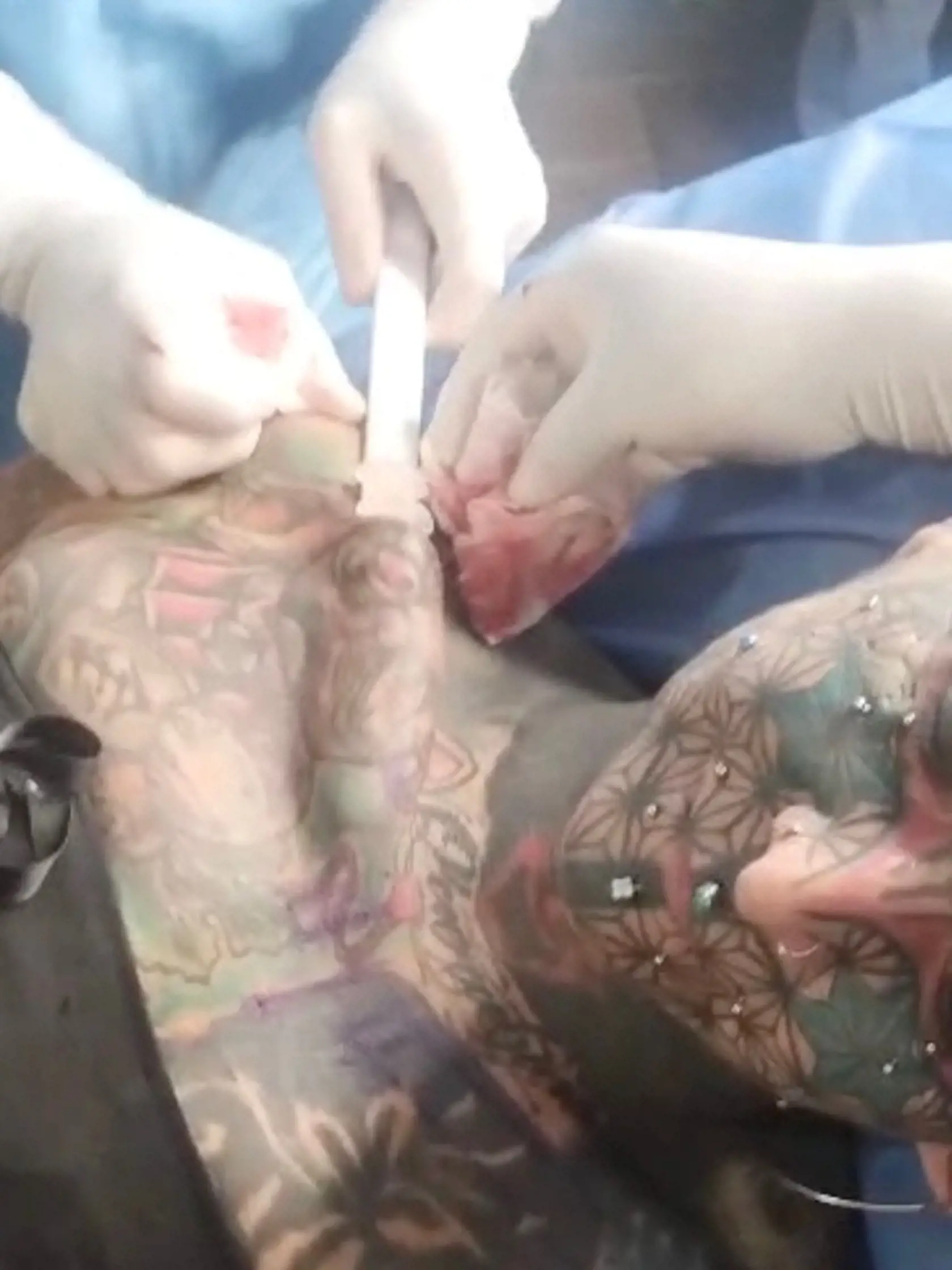 EXCLUSIVE: One half of extreme body mod couple called 'cherubs from hell' gets implants to make arms bigger