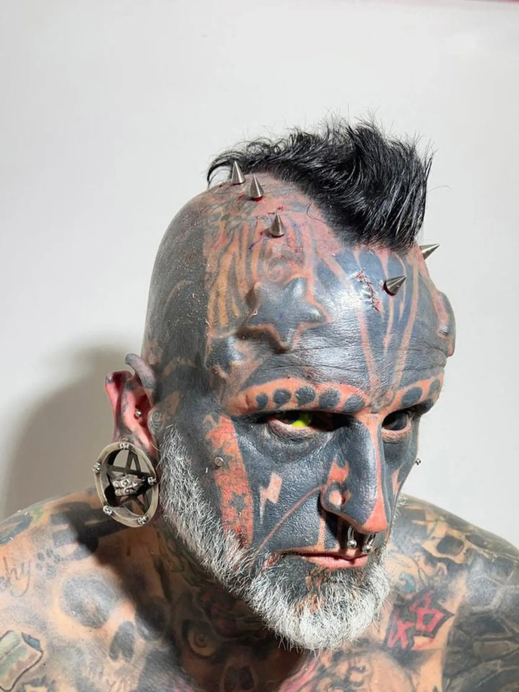 EXCLUSIVE: One half of extreme body mod couple called 'cherubs from hell' gets implants to make arms bigger