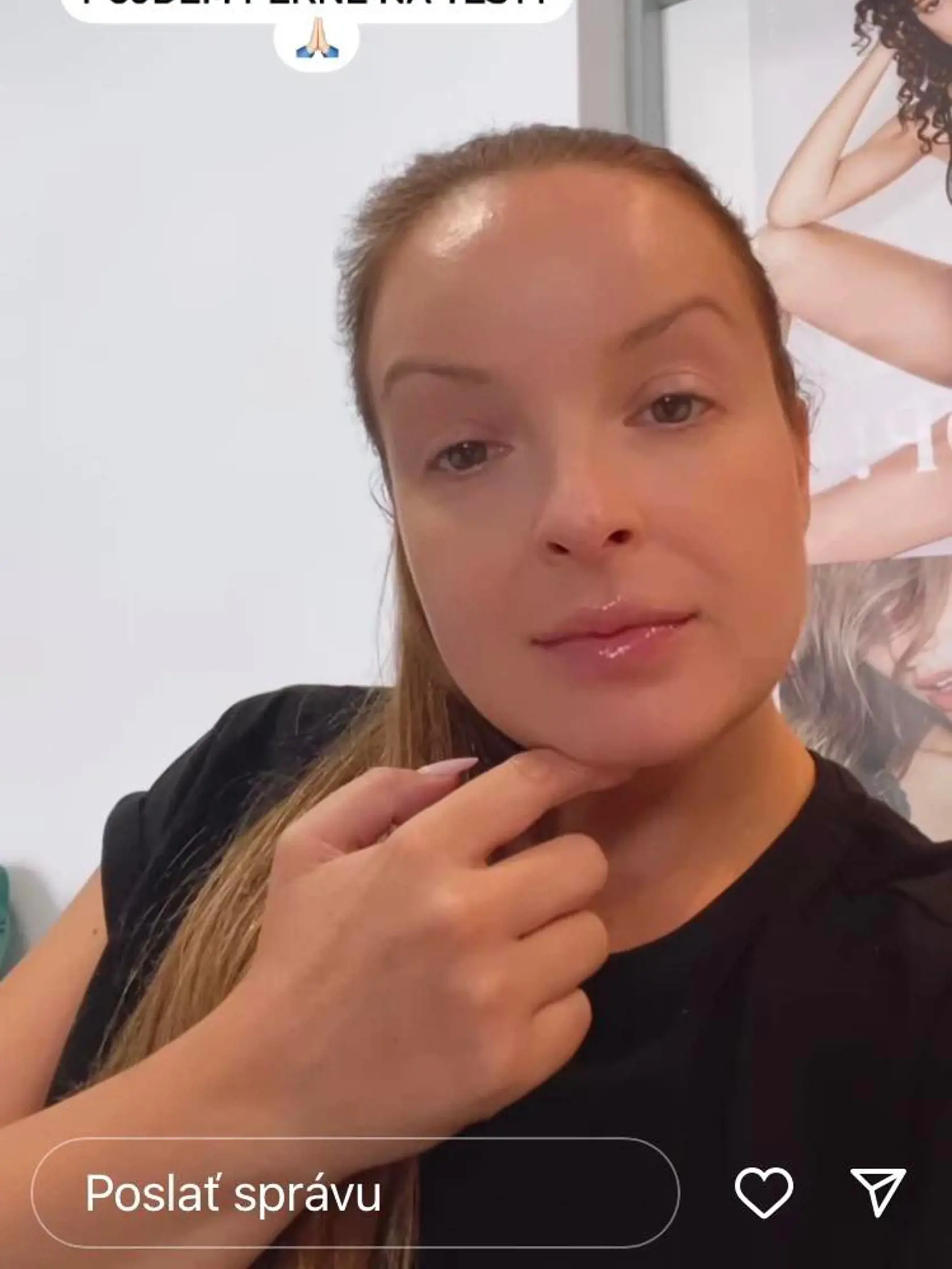 Twiinska Daniela Nízlová náhle skončila na urgentnom príjme. Dôvodom bola prudká alergická reakcia, z ktorej jej opuchla celá tvár vrátane pier aj jazyka.