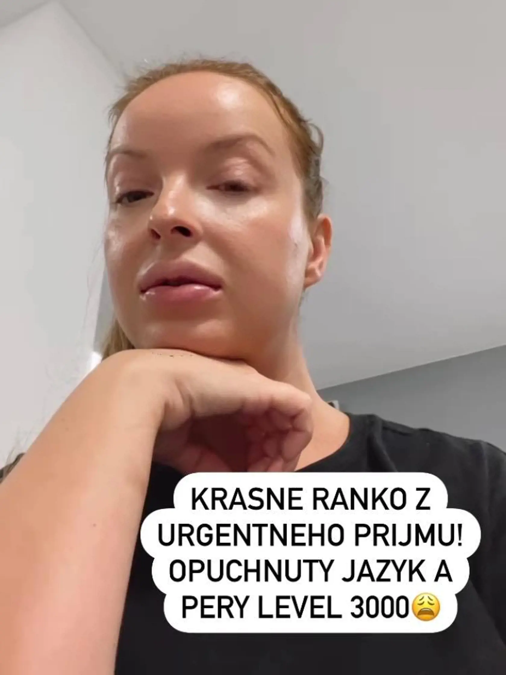 Twiinska Daniela Nízlová náhle skončila na urgentnom príjme. Dôvodom bola prudká alergická reakcia, z ktorej jej opuchla celá tvár vrátane pier aj jazyka.