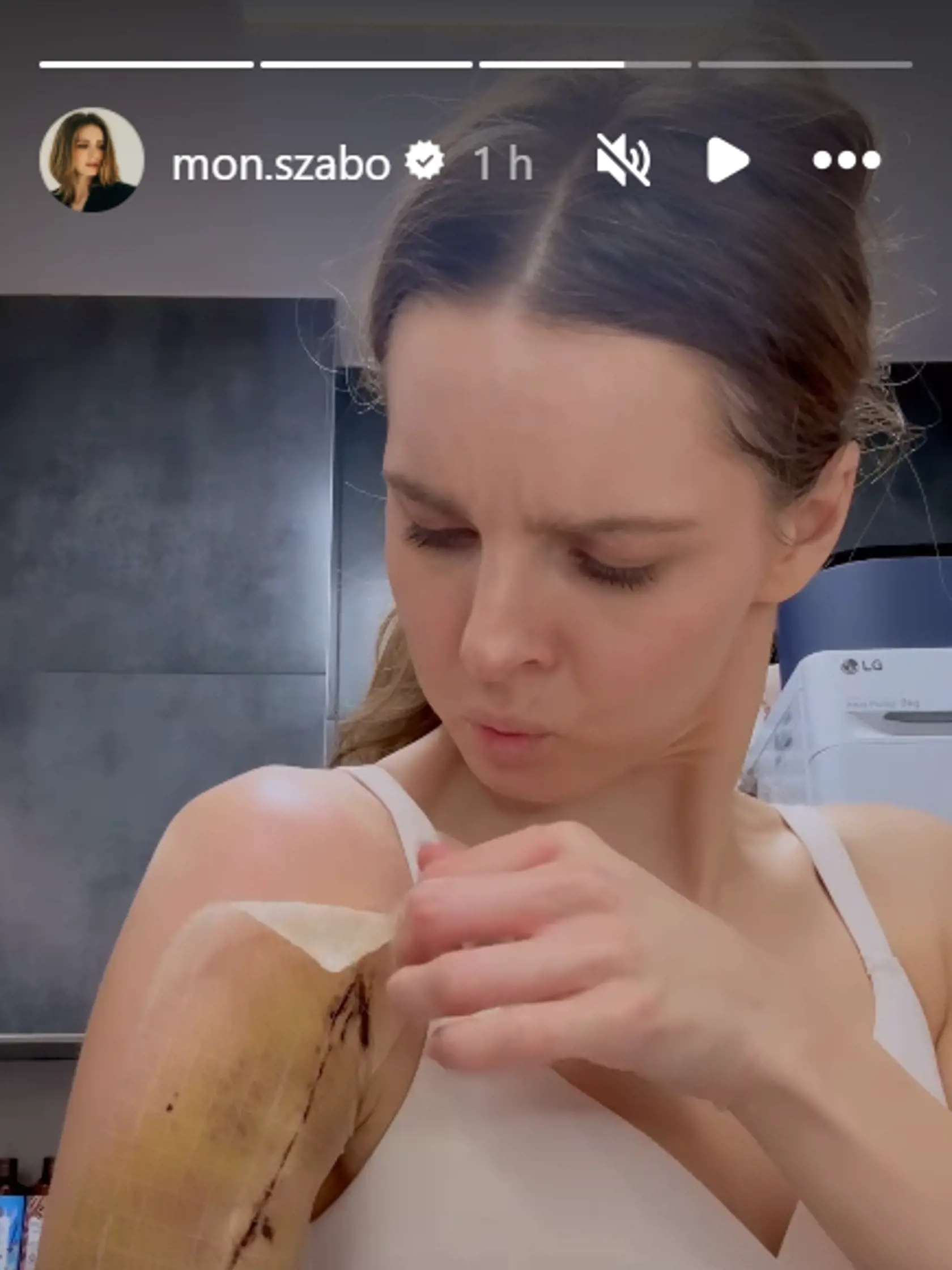 Herečka Monika Szabó ukázala, aká jazva jej po úraze na lyžiach ostala.