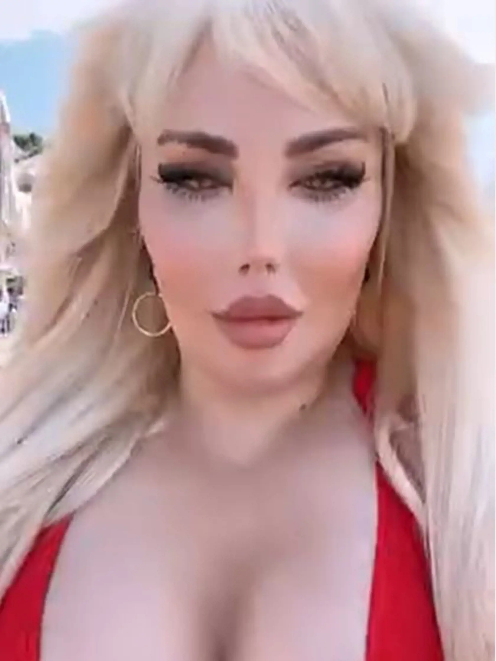 Jessica si po diagnóze obezity nechala zmenšiť žalúdok.