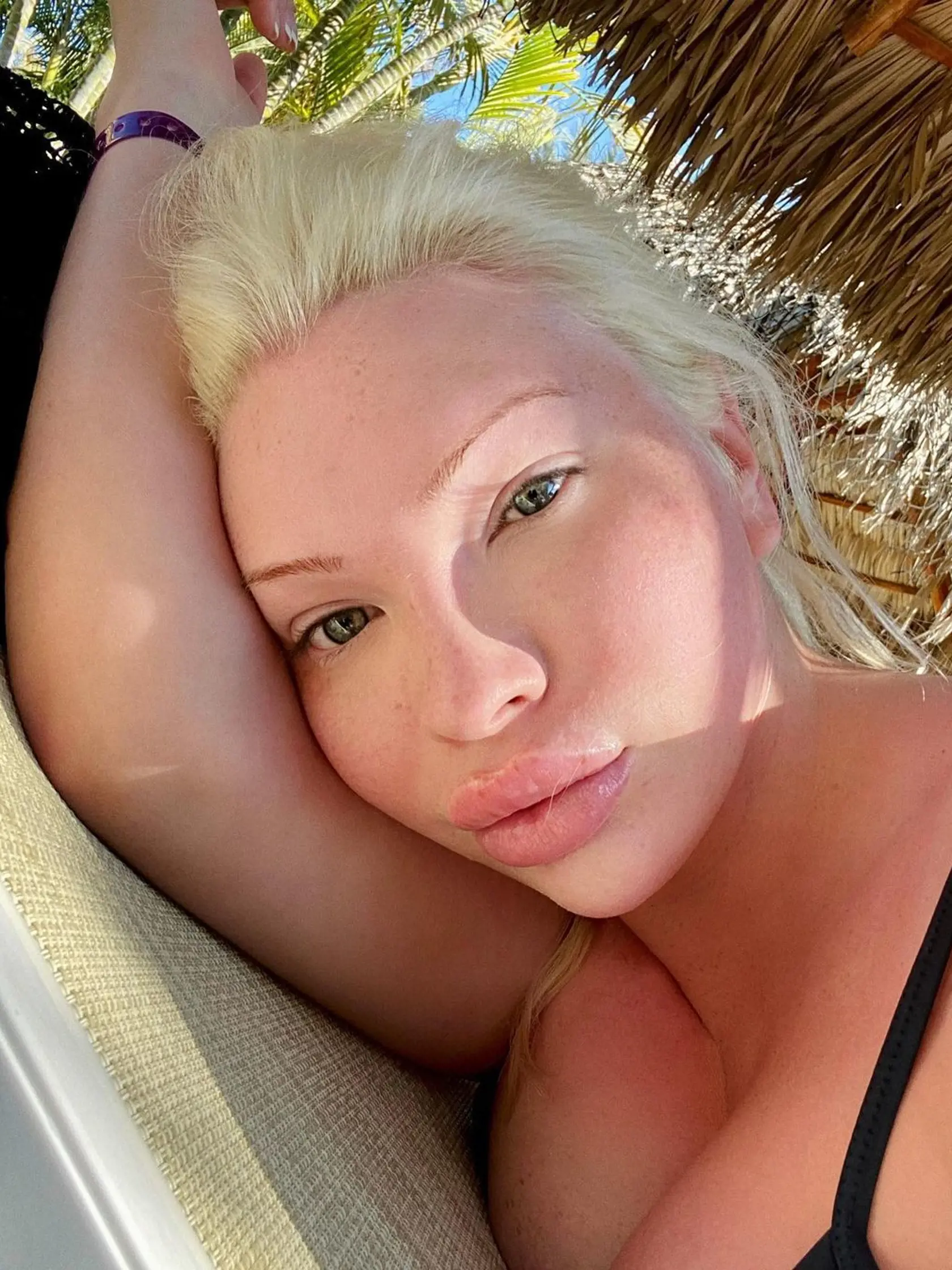 Má iba 23 rokov a množstvo plastických operácií: Chcela byť ako Marilyn Monroe, no je ako...Fú!