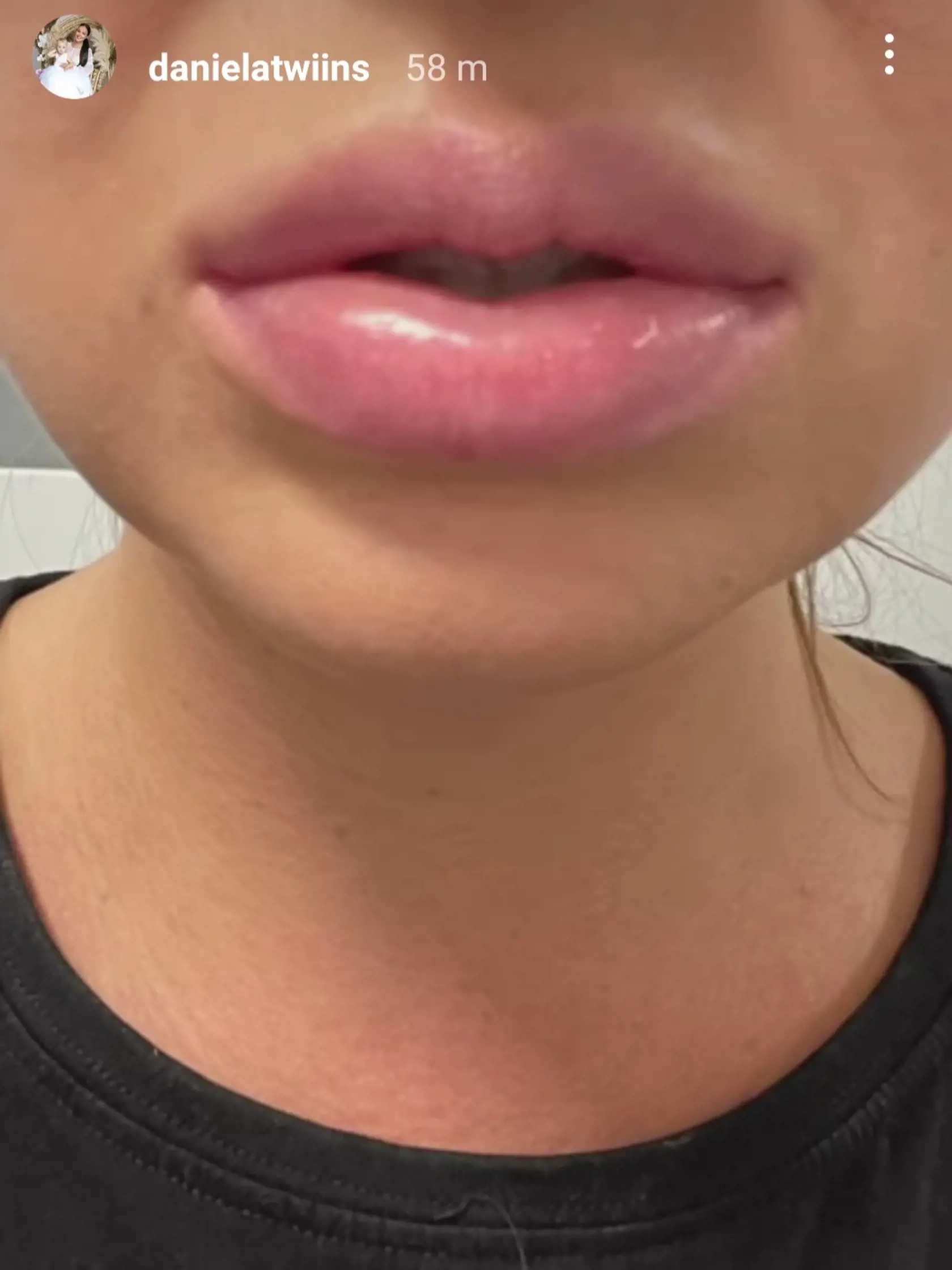 Daniela Nízlová sa ocitla v nemocnici. "Krásne ránko z urgentného príjmu! Opuchnutý jazyk a pery level 3000," napísala do jedného z príbehu, čo nám vyrazilo dych. Potom to aj priamo ukázala.