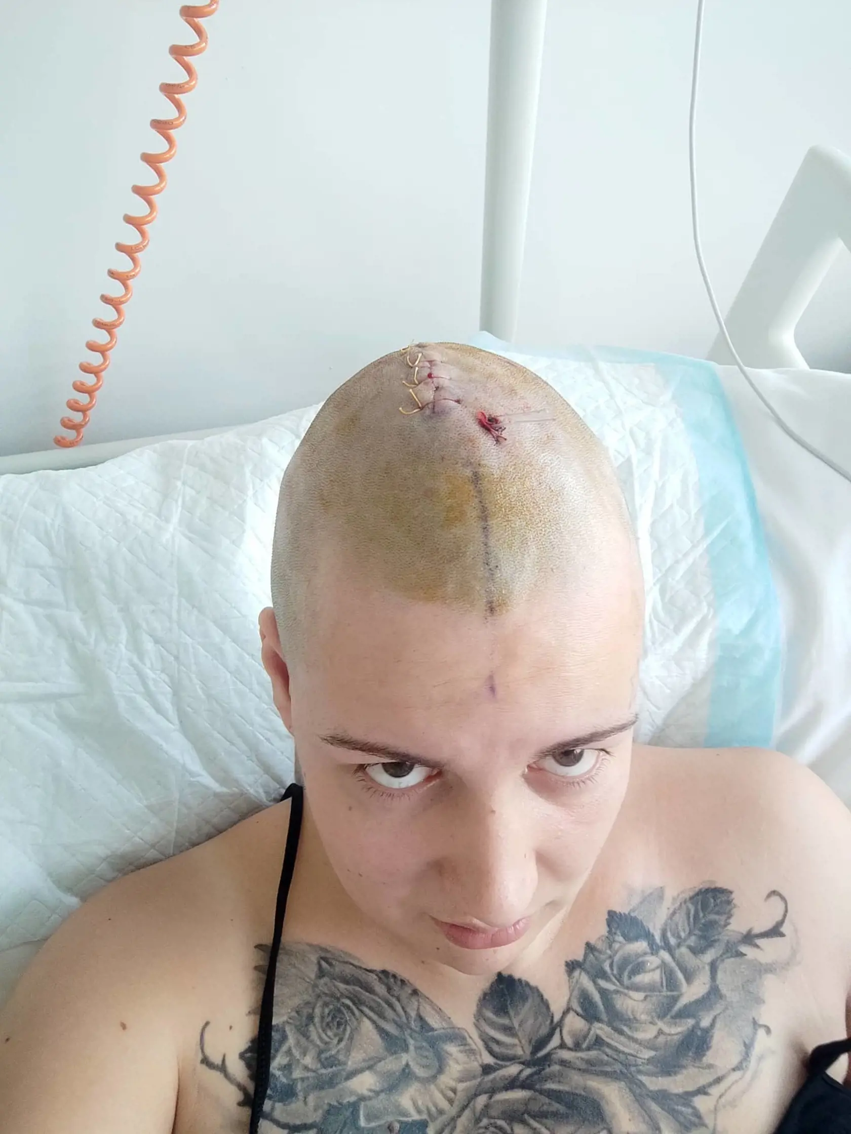 Martina po operácii hlavy. Lekári jej odobrali kus kosti