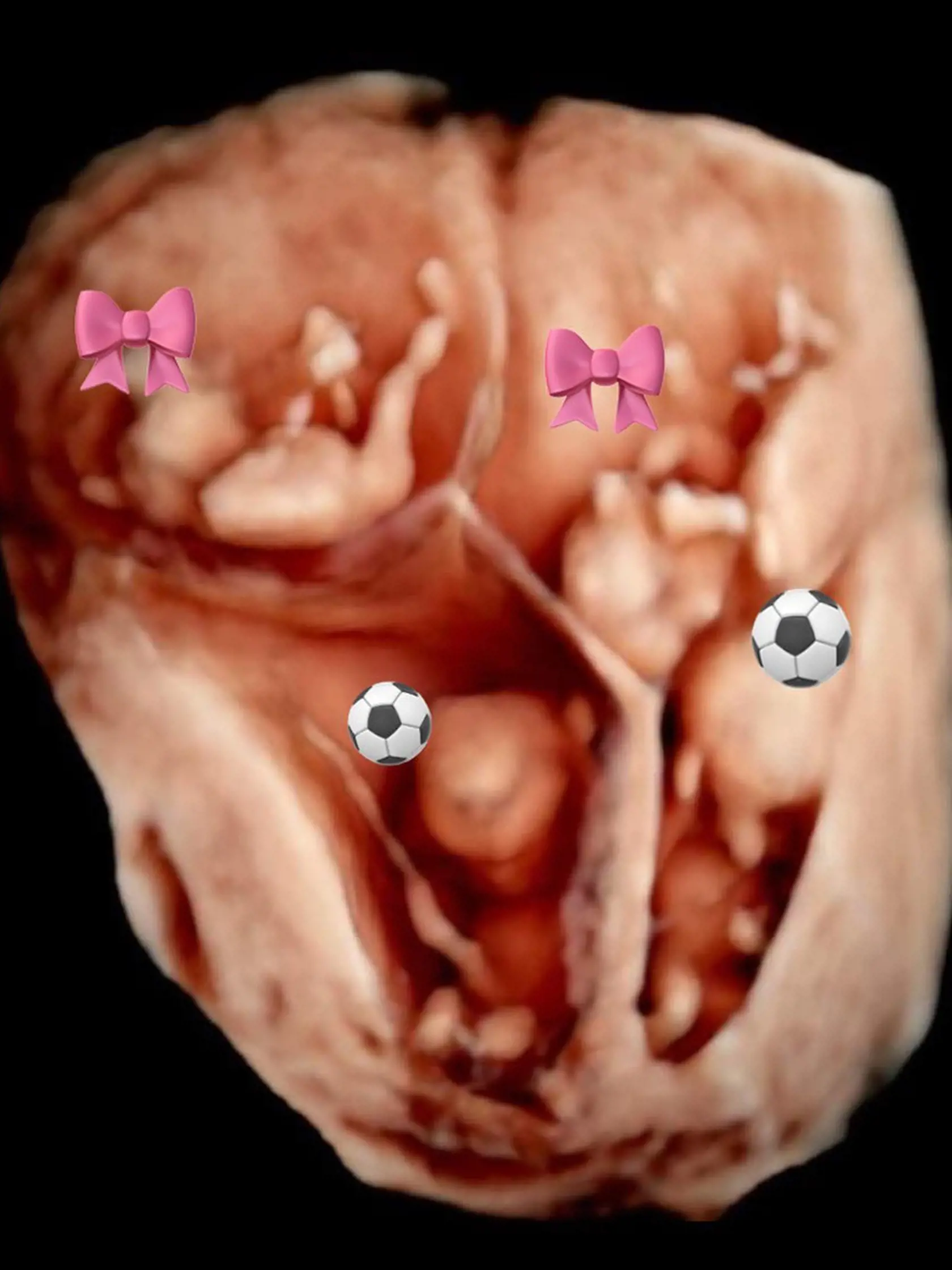 Manželom Križalkovičovcom priniesli štvorčatá štvornásobnú radosť. Vtipne označený ultrazvuk. (archívne foto)