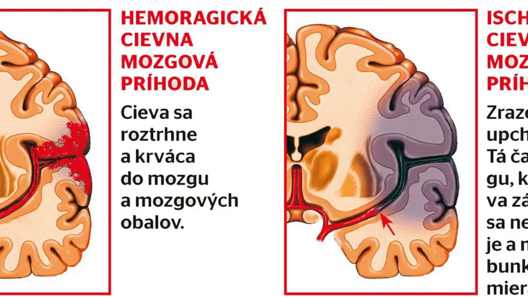 Cievna mozgová príhoda