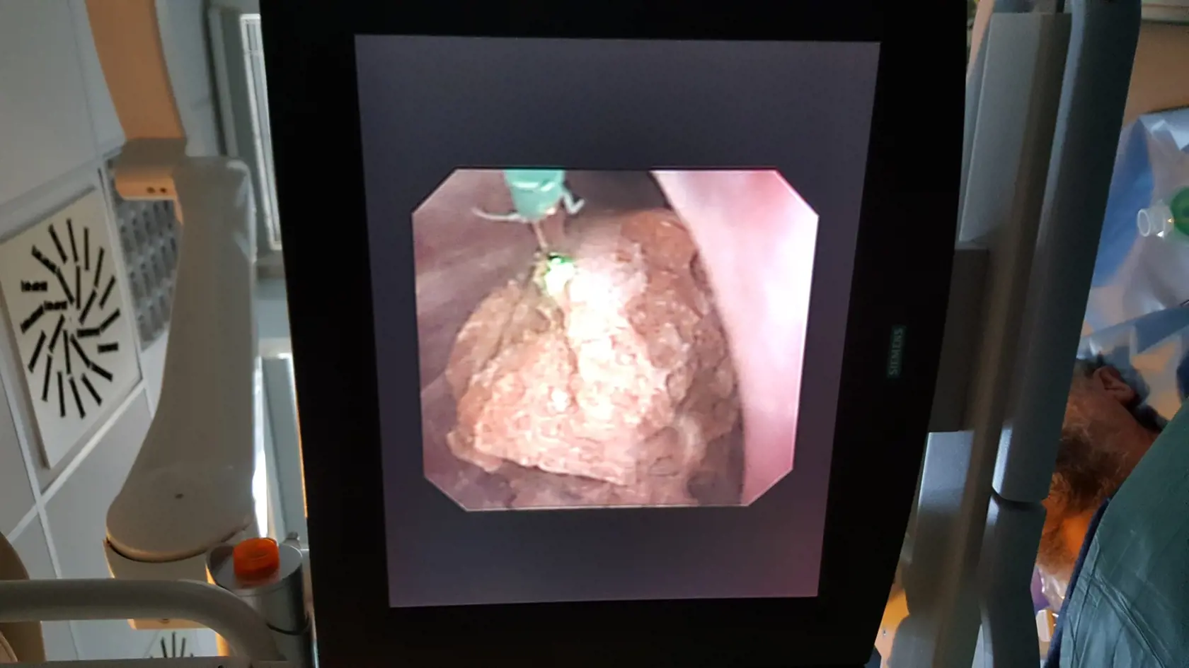 Na obrazovke lekári vidia zväčšeninu obrazu kameňa v obličke s laserovým vláknom (zelené), ktoré aktívne drví kameň buď na úplný prach alebo na drobné úlomky podľa nastavenia prístroja.