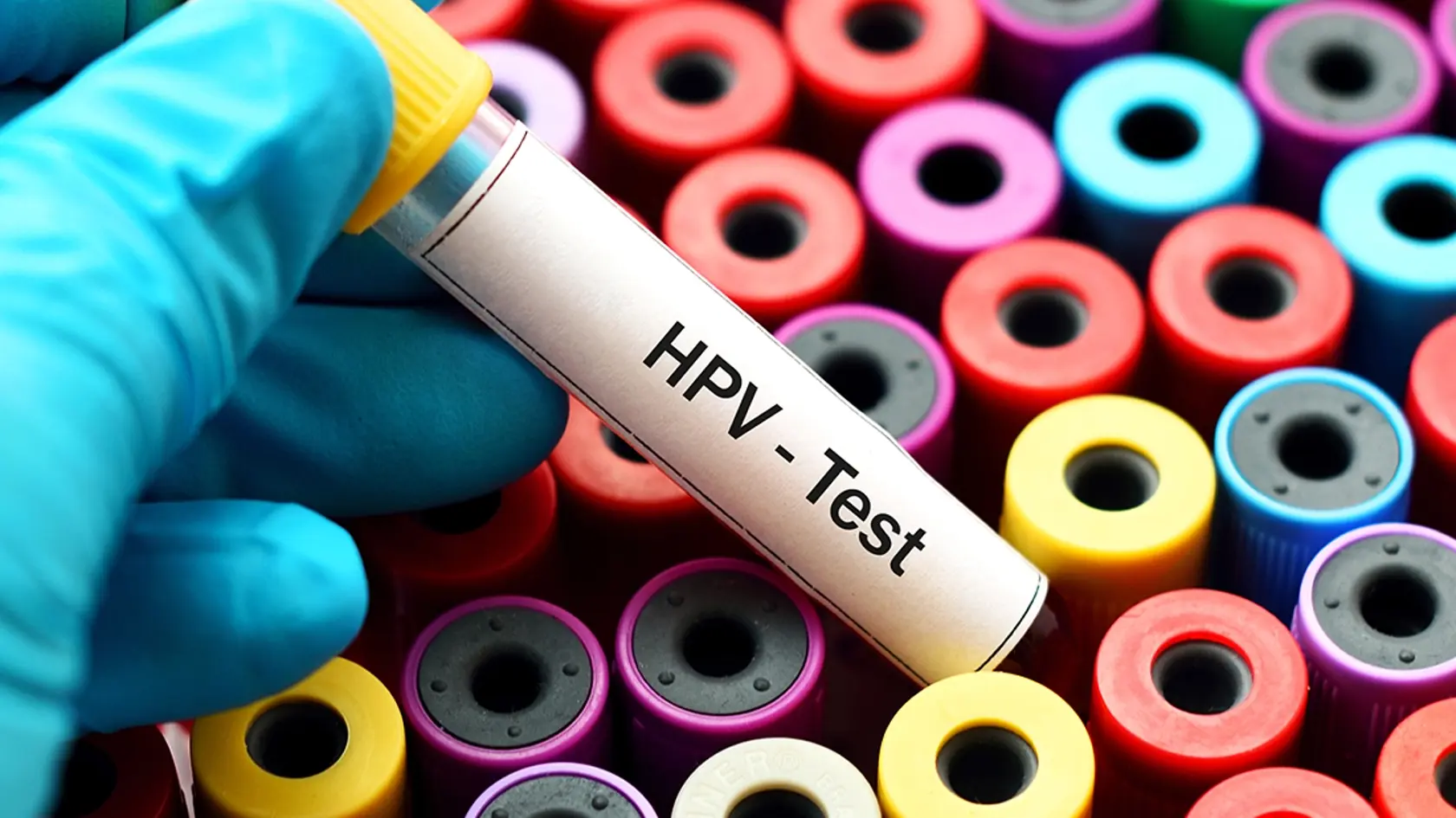 DNA HPV test je v niektorých krajinách prvou voľbou prevencie rakoviny krčka maternice.