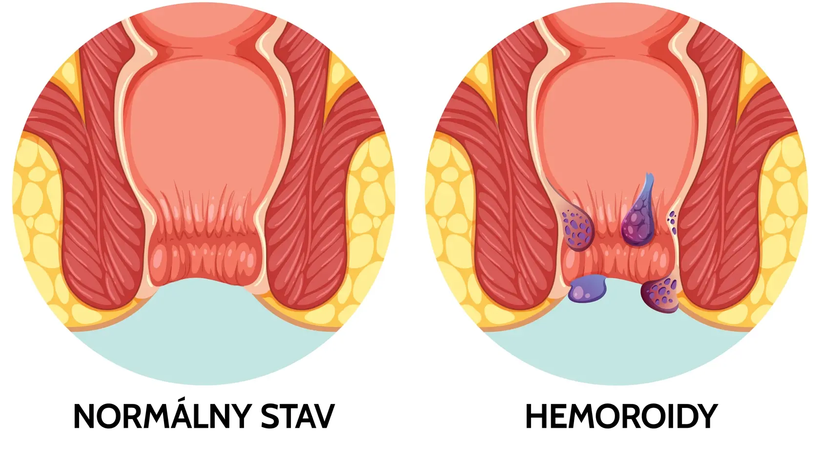 Hemoroidy: normálny stav a nález