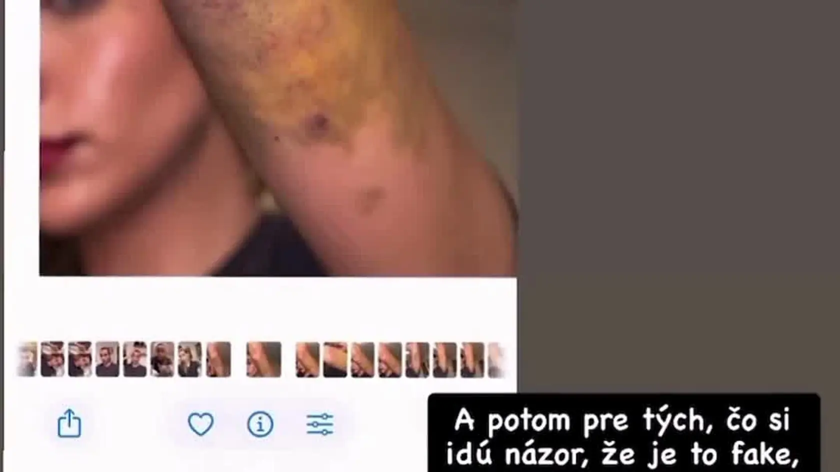 Petrana sa ozvala po útoku. Pozrite, aké hrozné modriny jej mal spôsobiť vlastný otec.
