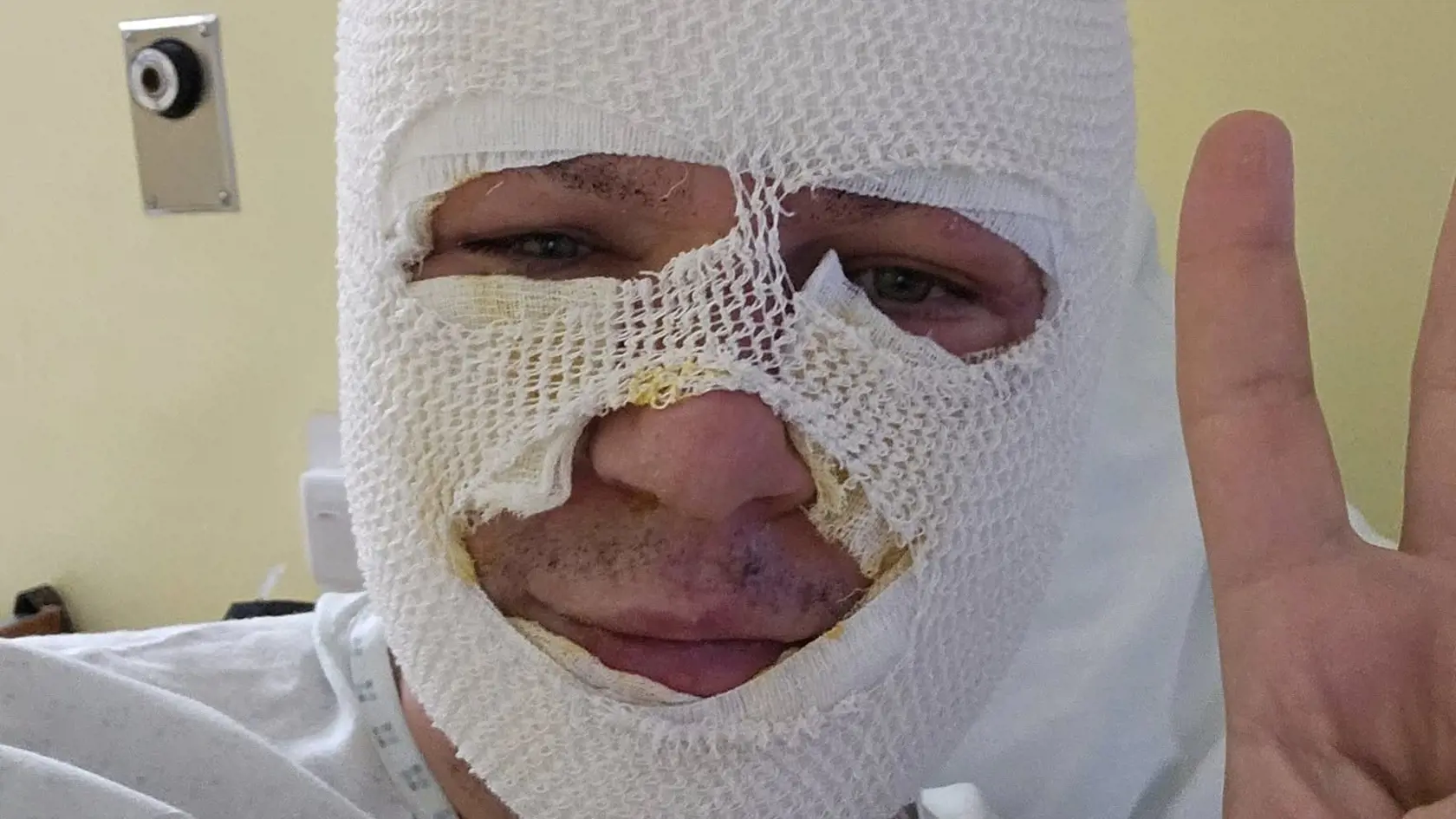 Miroslav Žiak si pri zapalovaní biokrbu spôsobil popáleniny.