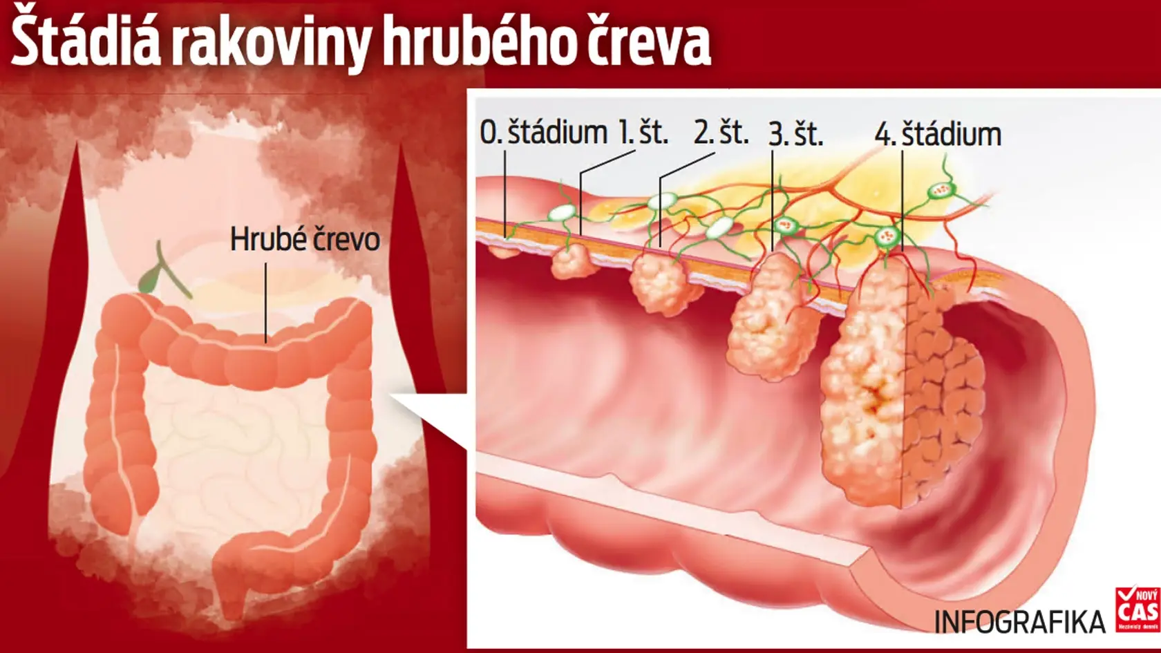 Štádiá rakoviny hrubého čreva
