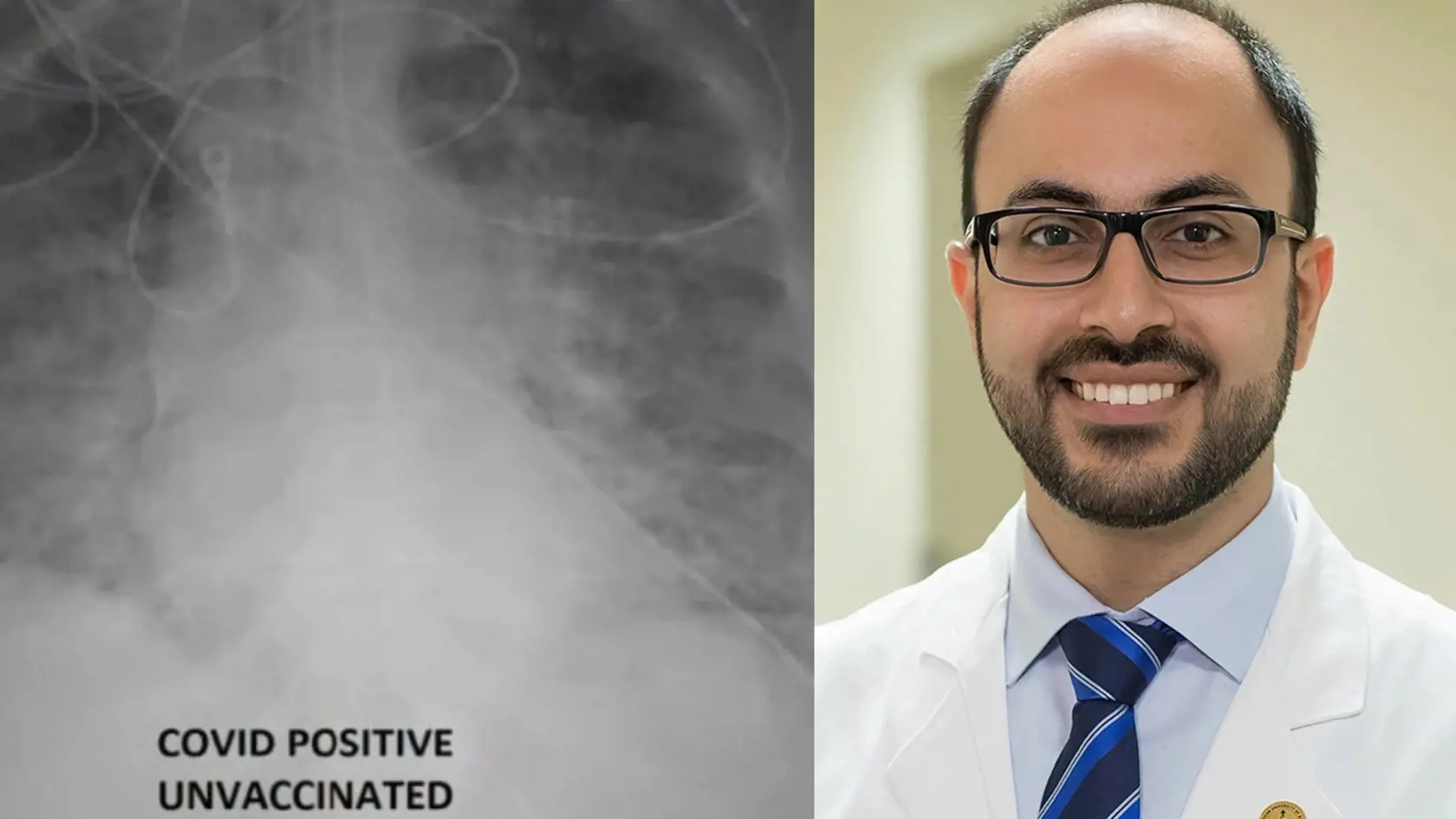 Lekár Ghassan Kamel popísal, čo spravila vakcína s pľúcami pacienta.