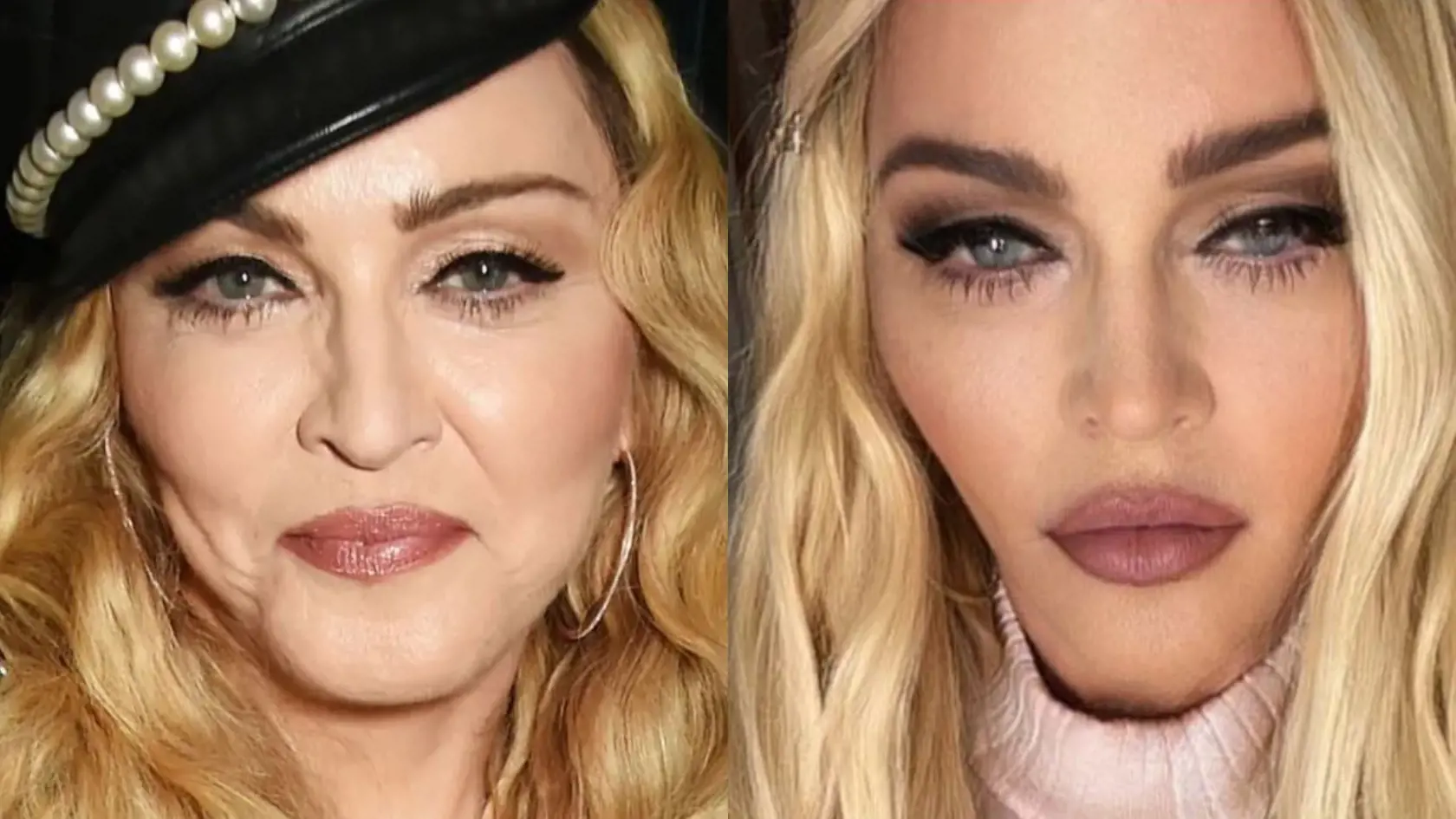 „Súdiac podľa fotografií by som povedal, že Madonna pravdepodobne absolvovala facelift, zdvihnutie horného a dolného viečka a endoskopický lifting. Madonna podľa všetkého podstúpila aj odstránenie bukálneho tuku, čo vytvára tenší profil a chudšie líca. Jej pokožka však vyzerá nedotknuto, čo je možný dôsledok viacerých chemických peelingov a laserových ošetrení,“ uviedol pre radaronline plastický chirurg doktor Youn.