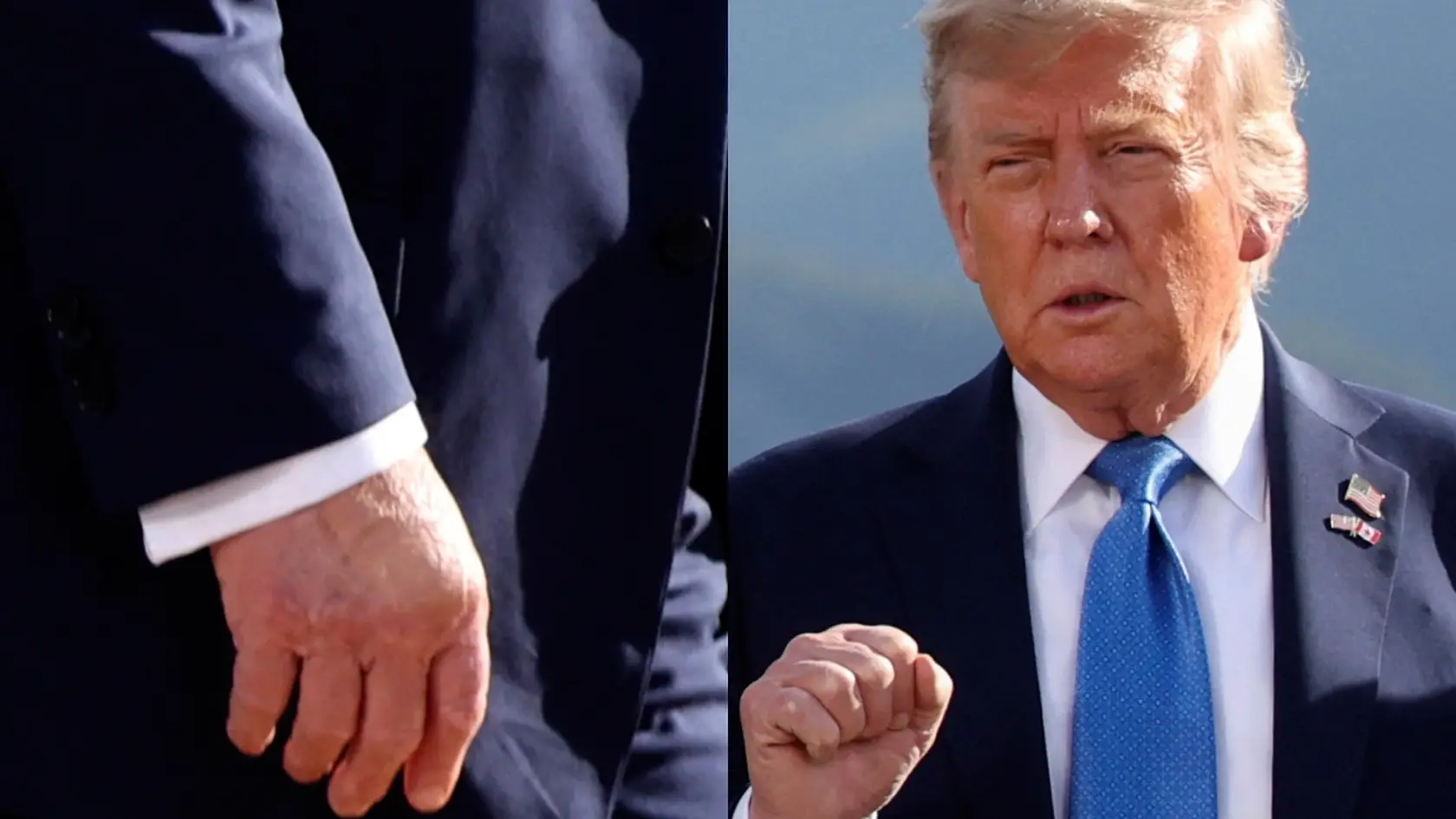 Americký prezident bol opäť zachytený na fotografii s veľkou modrinou na ruke, ktorá naviac pôsobí opuchnuto.
