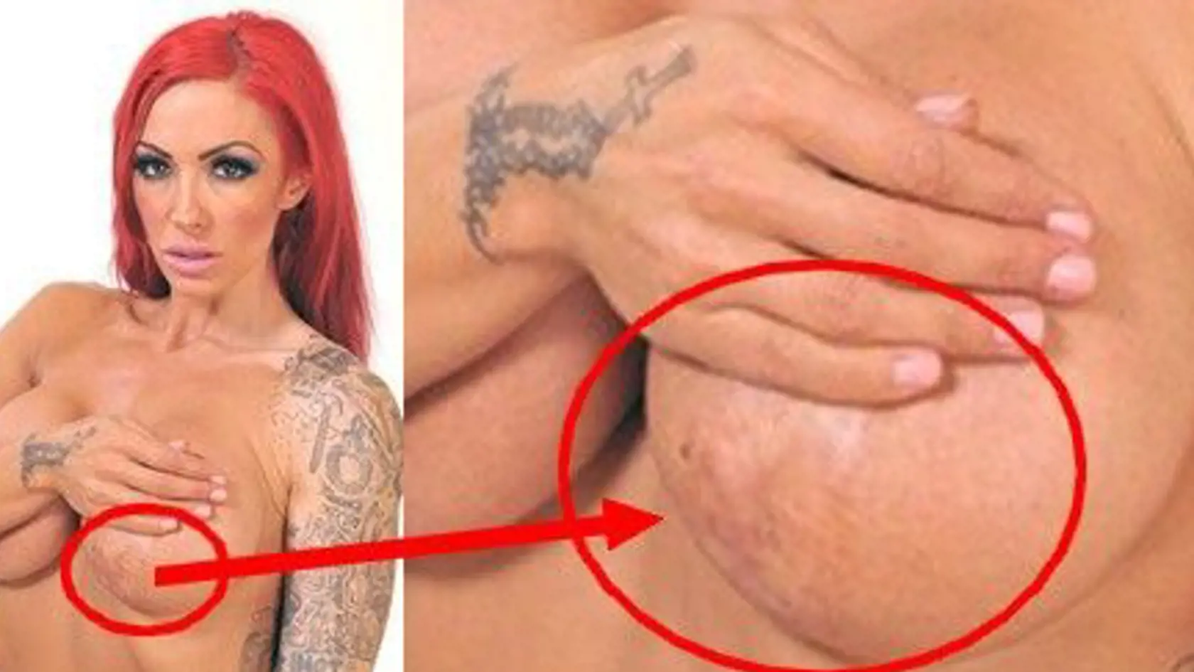 Ľavý prsník modelky Jodie Marsh hyzdí obrovská