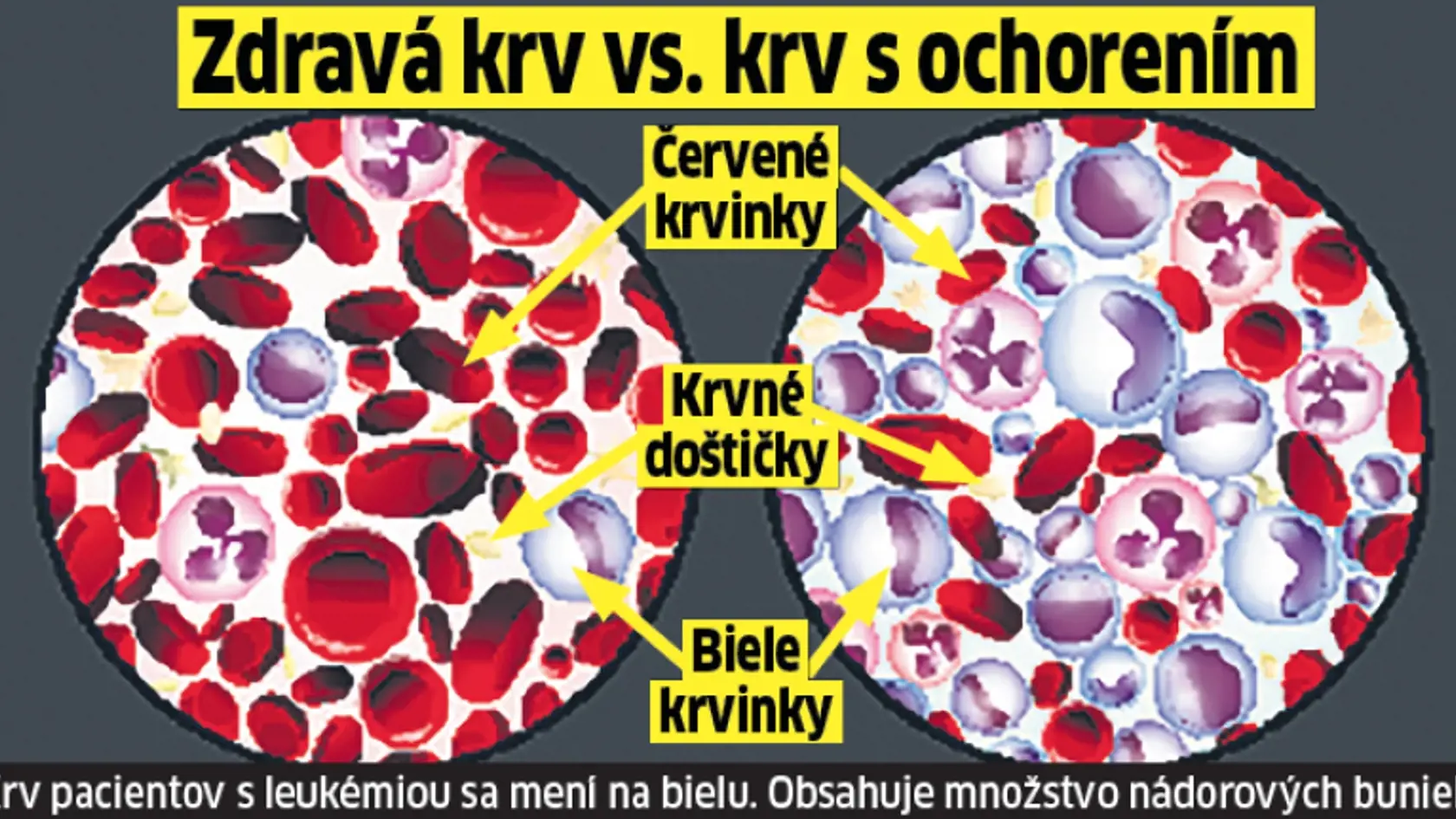 Ako sa zmení krv človeka, ktorý ochorie na akútnu leukémiu.