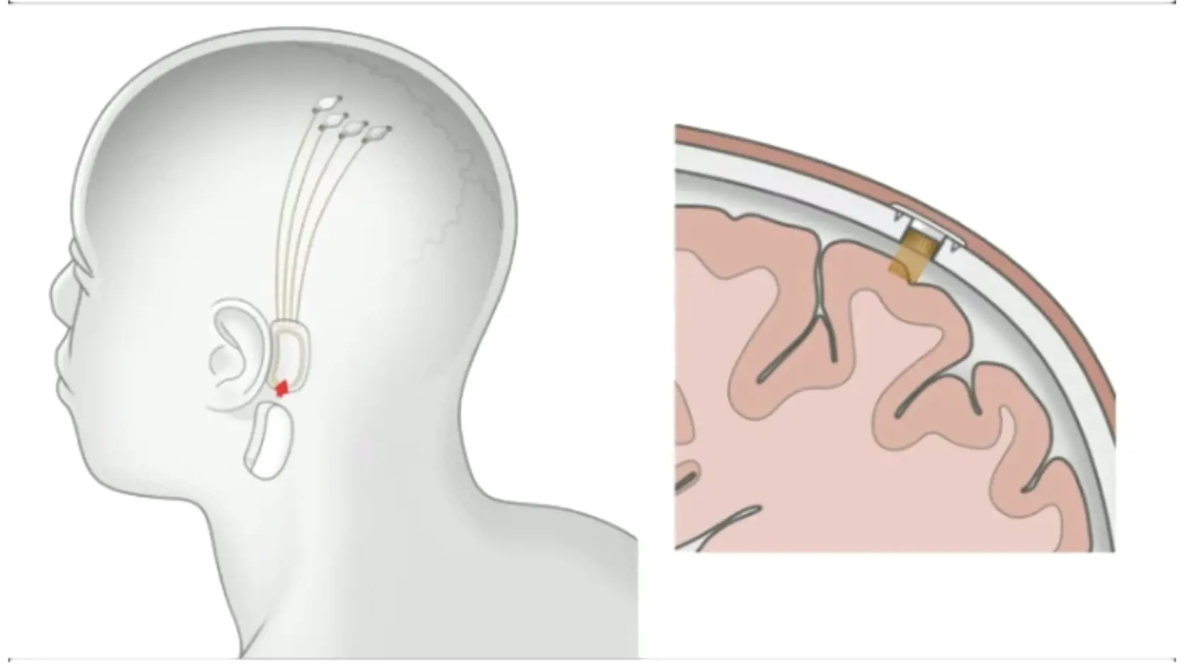 Americké úrady dali súhlas na testovanie mozgových implantátov na ľuďoch