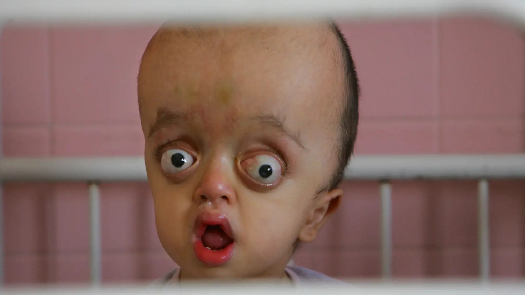 Desivé následky vojny vo Vietname trvajú dodnes. Potom, čo Amerika vypustila chemickú zbraň s názvom Agent Orange sa dodnes rodia deti s genetickou poruchou.