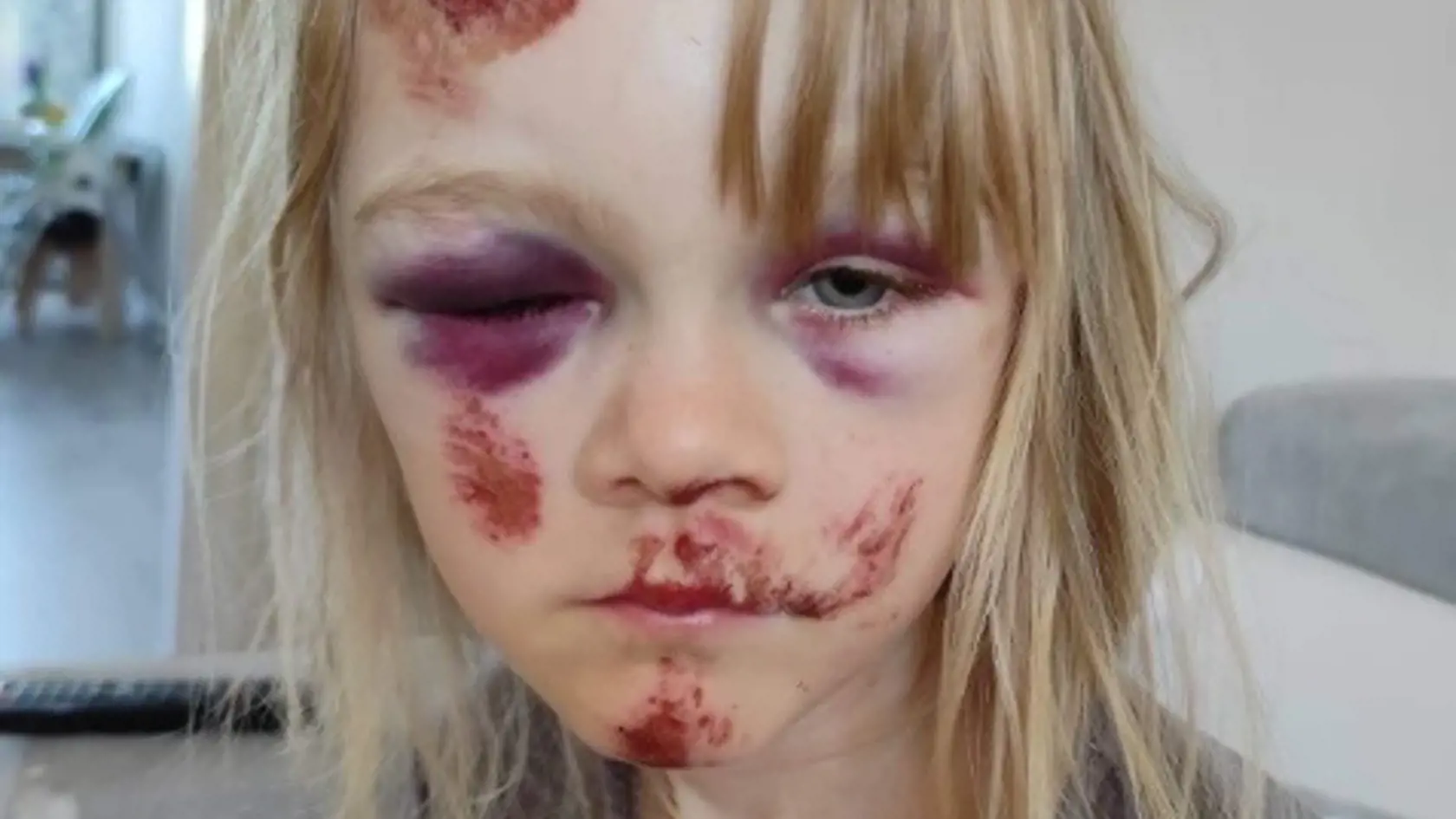 Nelinka  (7)  je po páde doudieraná najmä na tvári. Udreté má aj rebrá. Namiesto užívania si prázdnin, dievčatko musí byť doma a v kľude. Otec podpísal reverz a zobral ju z nemocnice do domáceho liečenia.