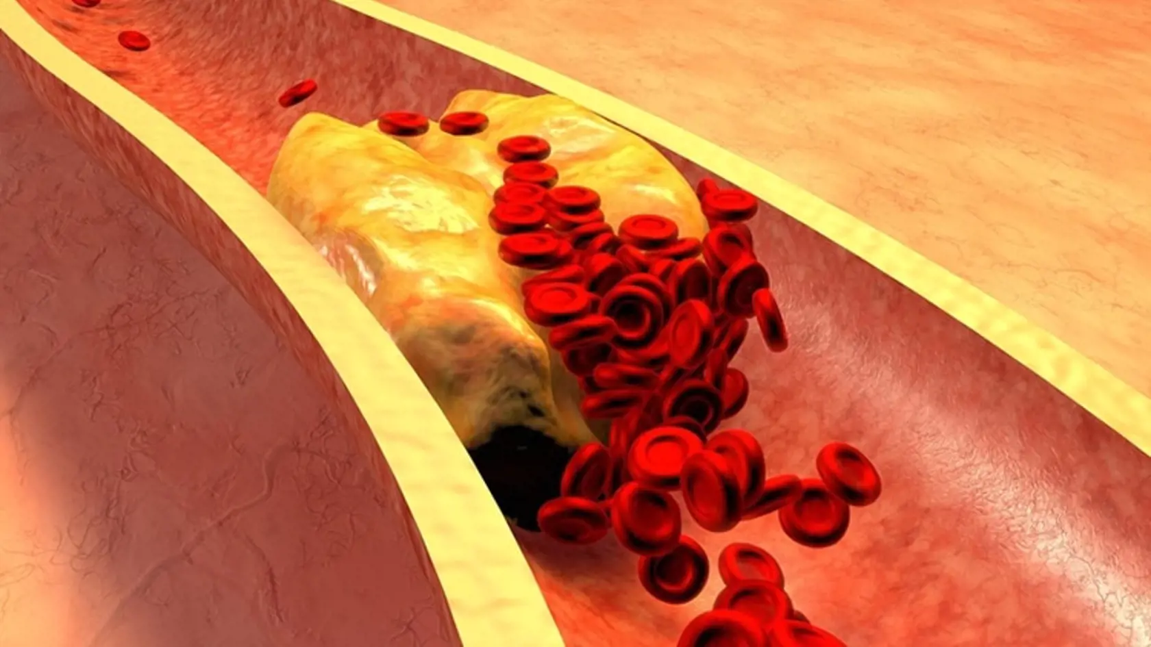Ak je v cieve priveľa cholesterolu, usádza sa na cievnych stenách a upcháva ich priechodnosť.