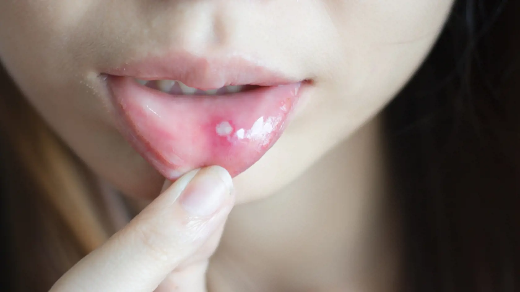 Za aftami sa môže skrývať celiakia, alergia, Crohnova choroba, ulcerózna kolitída, nedostatok vitamínov a minerálov, leukémia.