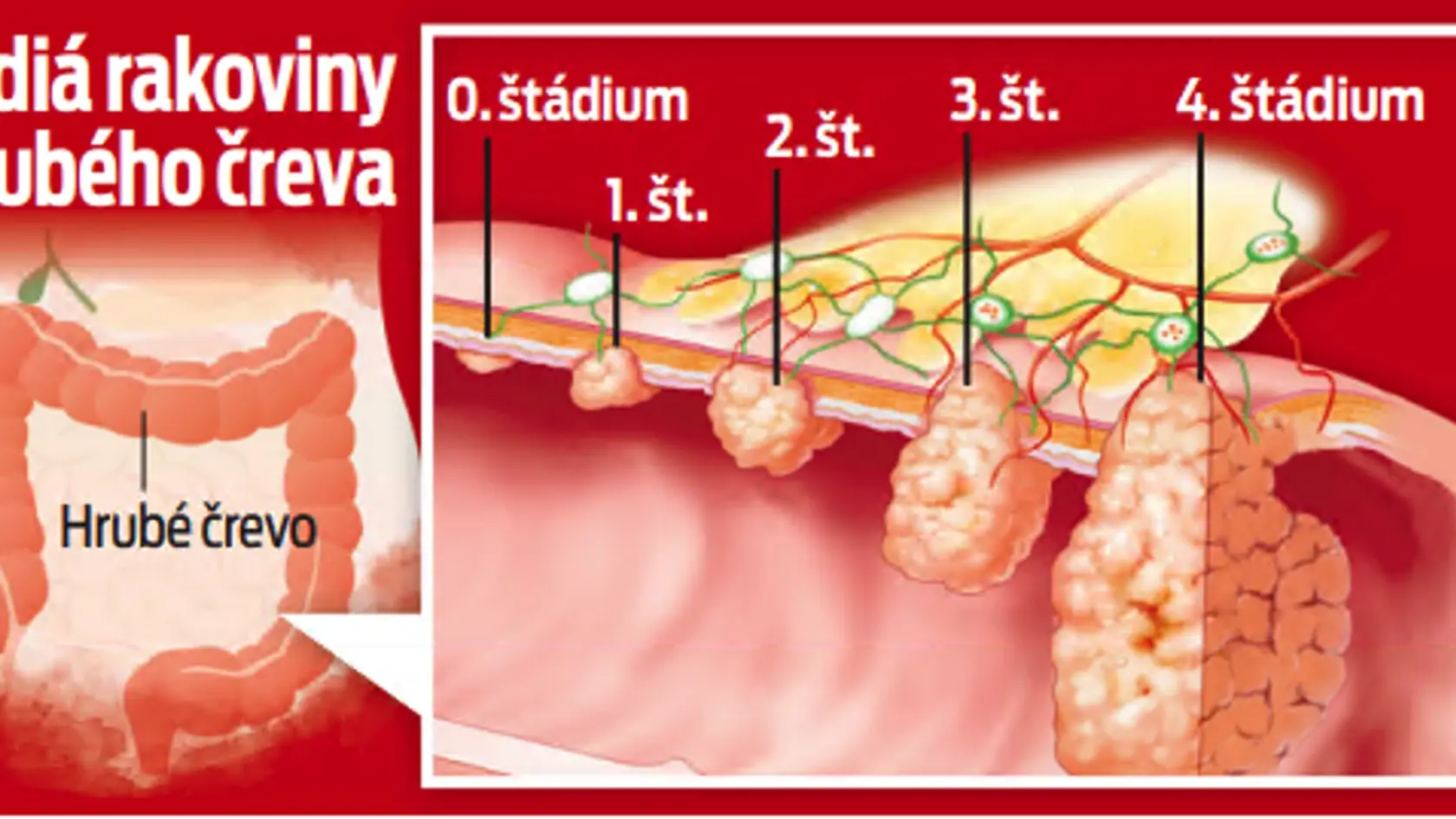Štádiá rakoviny hrubého čreva