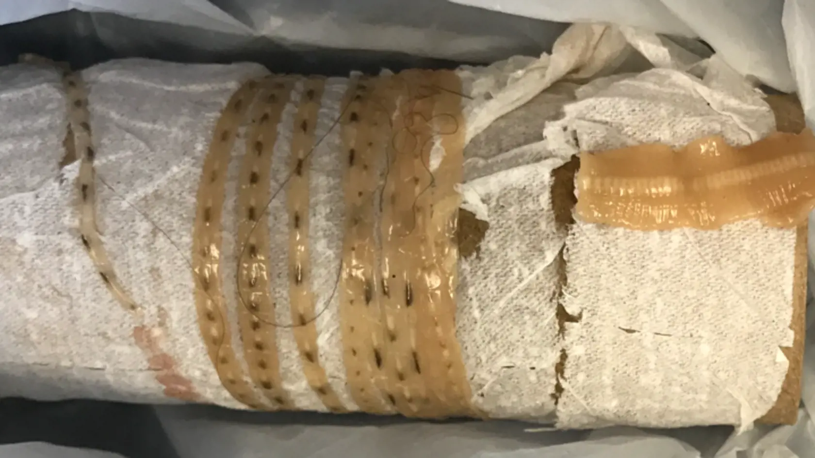 Z milovníka sushi vytiahli 167-centimetrovú pásomnicu.